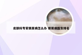 皮肤科专家银屑病怎么办 银屑病医生排名