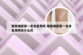 银屑病感冒一定会复发吗 银屑病感冒一定会复发吗吃什么药