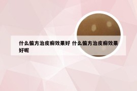 什么偏方治皮癣效果好 什么偏方治皮癣效果好呢