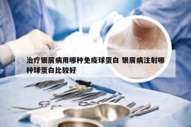 治疗银屑病用哪种免疫球蛋白 银屑病注射哪种球蛋白比较好