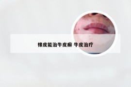 橡皮能治牛皮癣 牛皮治疗