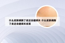 什么皮肤病撕了皮还会继续长 什么皮肤病撕了皮还会继续长皮屑