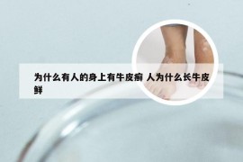 为什么有人的身上有牛皮癣 人为什么长牛皮鲜