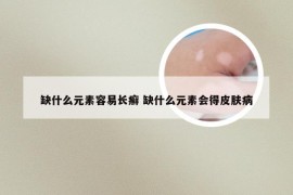 缺什么元素容易长癣 缺什么元素会得皮肤病