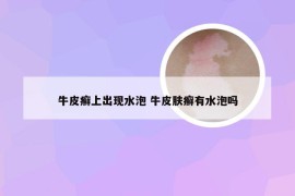 牛皮癣上出现水泡 牛皮肤癣有水泡吗