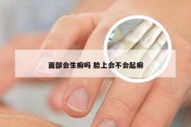 面部会生癣吗 脸上会不会起癣