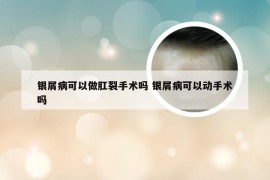 银屑病可以做肛裂手术吗 银屑病可以动手术吗