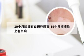 19个月脸庞有白斑咋回事 19个月宝宝脸上有白癣