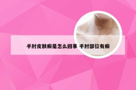 手肘皮肤癣是怎么回事 手肘部位有癣