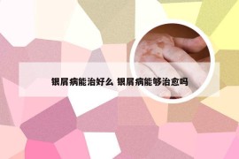 银屑病能治好么 银屑病能够治愈吗