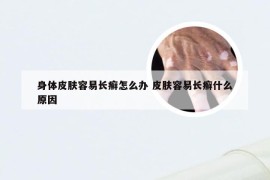 身体皮肤容易长癣怎么办 皮肤容易长癣什么原因