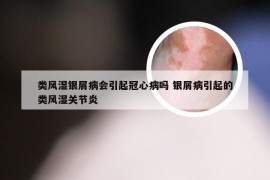 类风湿银屑病会引起冠心病吗 银屑病引起的类风湿关节炎