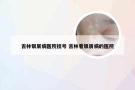 吉林银屑病医院挂号 吉林看银屑病的医院