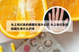 头上有红色的癣图片用什么药 头上有红色的癣图片用什么药膏