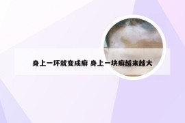 身上一坏就变成癣 身上一块癣越来越大