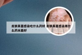 皮肤真菌感染吃什么药好 皮肤真菌感染用什么药水最好