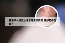 腿梁子长癣流水非常痒用什药膏 腿部起癣怎么办