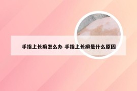 手指上长癣怎么办 手指上长癣是什么原因