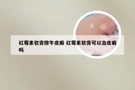 红霉素软膏擦牛皮癣 红霉素软膏可以治皮癣吗