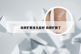 白斑扩散多久能好 白斑扩散了