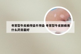 寻常型牛皮癣传染不传染 寻常型牛皮肤癣用什么药膏最好