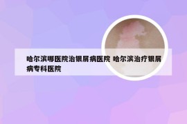 哈尔滨哪医院治银屑病医院 哈尔滨治疗银屑病专科医院