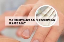 全身皮癣跟甲醛有关系吗 全身皮癣跟甲醛有关系吗怎么治疗