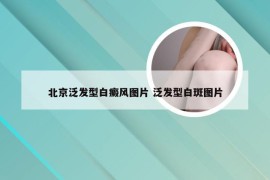 北京泛发型白癜风图片 泛发型白斑图片