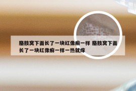 胳肢窝下面长了一块红像癣一样 胳肢窝下面长了一块红像癣一样一热就痒