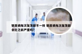 银屑病每次复发都不一样 银屑病每次复发都会比之前严重吗?