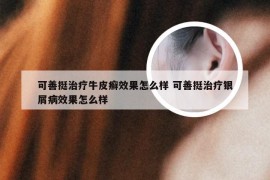 可善挺治疗牛皮癣效果怎么样 可善挺治疗银屑病效果怎么样