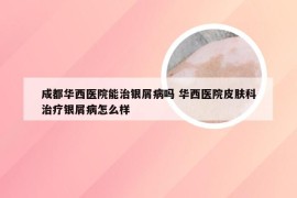 成都华西医院能治银屑病吗 华西医院皮肤科治疗银屑病怎么样