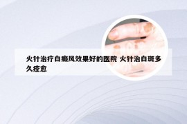 火针治疗白癜风效果好的医院 火针治白斑多久痊愈