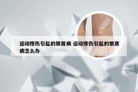 运动擦伤引起的银屑病 运动擦伤引起的银屑病怎么办