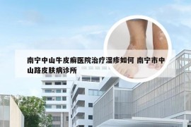 南宁中山牛皮癣医院治疗湿疹如何 南宁市中山路皮肤病诊所