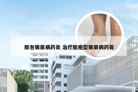 脓包银屑病药膏 治疗脓疱型银屑病药膏