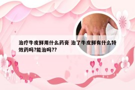 治疗牛皮鲜用什么药膏 治了牛皮鲜有什么特效药吗?能治吗??