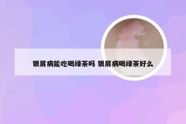 银屑病能吃喝绿茶吗 银屑病喝绿茶好么