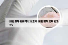 脓包型牛皮癣可以治愈吗 脓包型牛皮屑能治好?