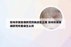 郑州市银屑病研究院杨淑莲正规 郑州市银屑病研究所看病怎么样