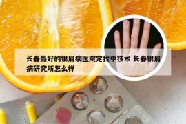 长春最好的银屑病医院定找中技术 长春银屑病研究所怎么样