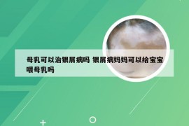 母乳可以治银屑病吗 银屑病妈妈可以给宝宝喂母乳吗