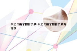 头上长癣了擦什么药 头上长癣了擦什么药好得快