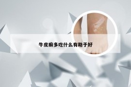 牛皮癣多吃什么有助于好