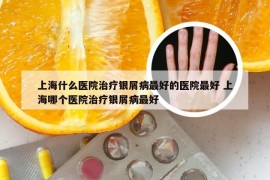 上海什么医院治疗银屑病最好的医院最好 上海哪个医院治疗银屑病最好