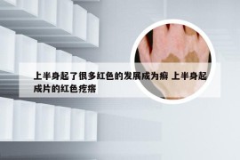 上半身起了很多红色的发展成为癣 上半身起成片的红色疙瘩