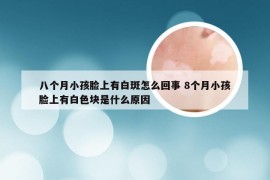 八个月小孩脸上有白斑怎么回事 8个月小孩脸上有白色块是什么原因