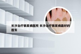 长沙治疗银屑病医院 长沙治疗银屑病最好的医生