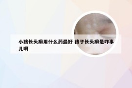 小孩长头癣用什么药最好 孩子长头癣是咋事儿啊