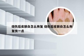 烧伤后皮肤白怎么恢复 烧伤后皮肤白怎么恢复快一点